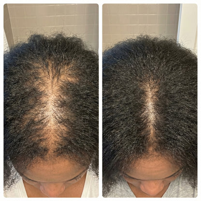 Hair Regrowth Gummies