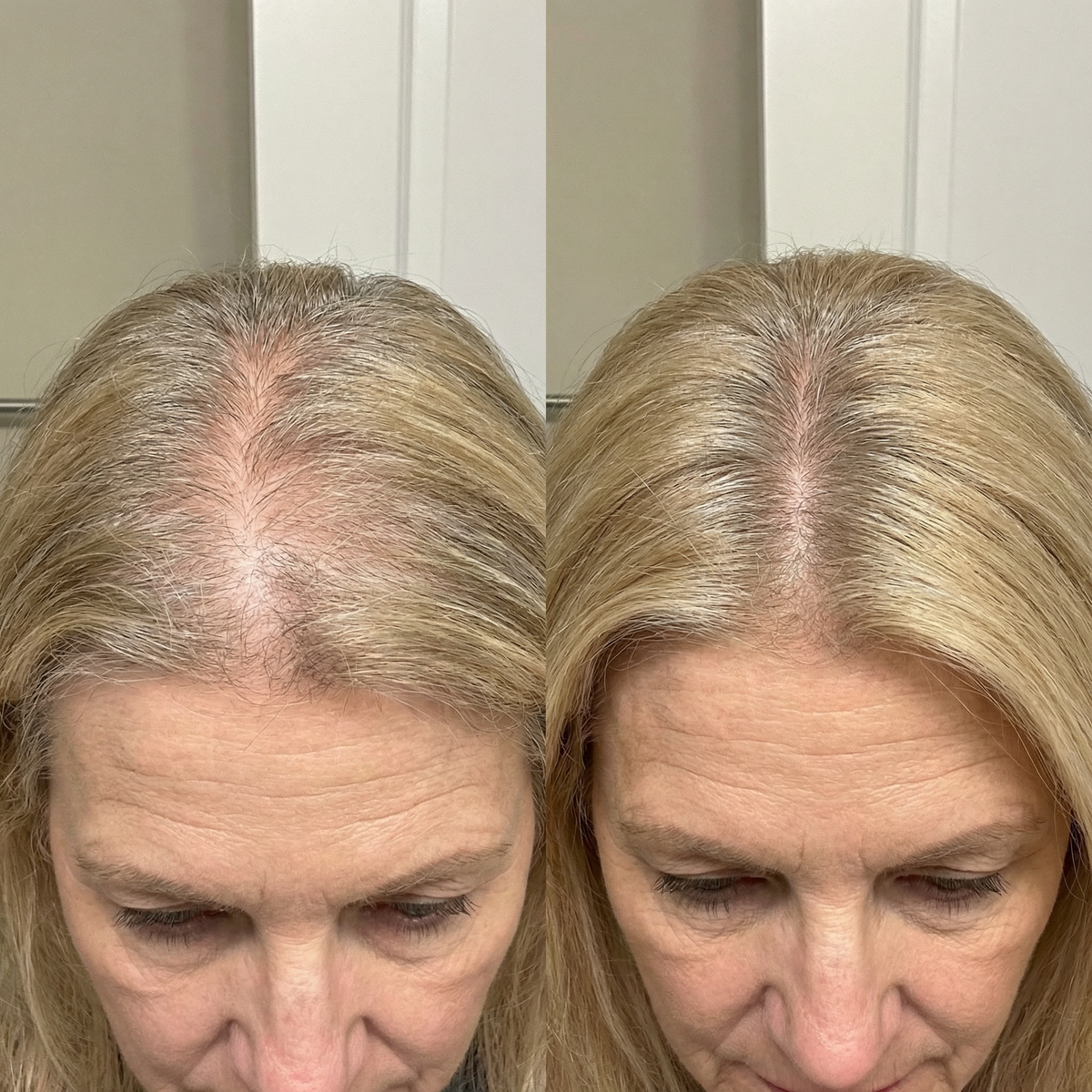 Hair Regrowth Gummies