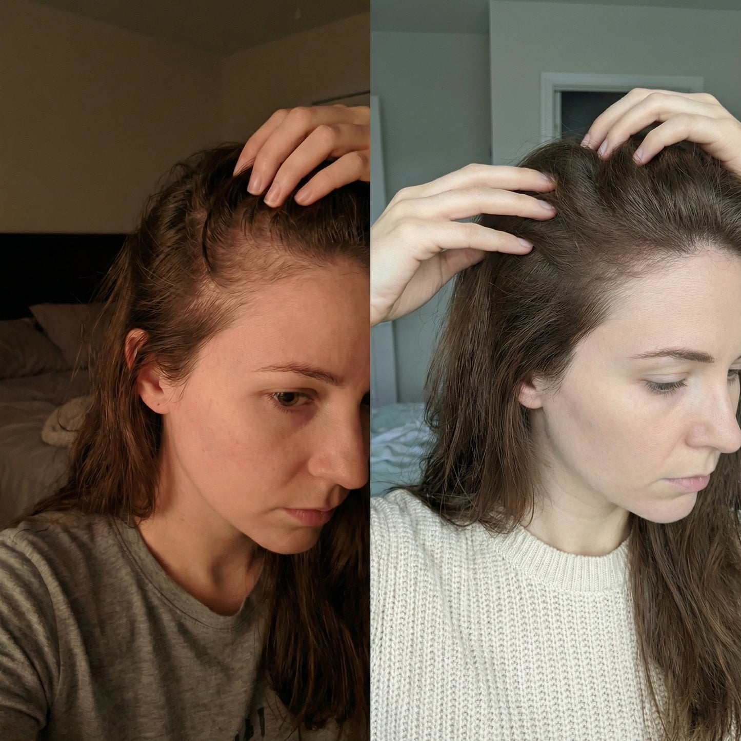 Hair Regrowth Gummies